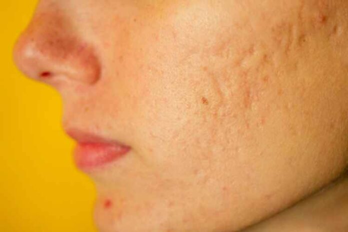 Help Acne Scars Fade Away Faster With These Treatments